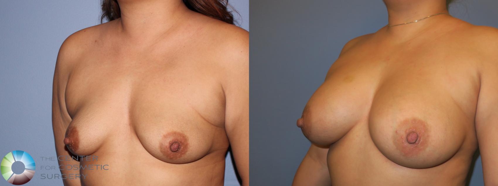 Best Denver Colorado Breast Implants Augmentation