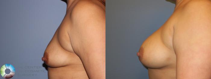 Before & After Breast Augmentation Case 11356 Left Side View in Golden, CO