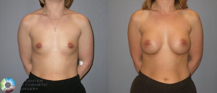 Before & After Breast Augmentation Case 114 View #1 in Denver and Colorado Springs, CO
