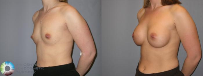 Before & After Breast Augmentation Case 114 View #2 in Denver and Colorado Springs, CO
