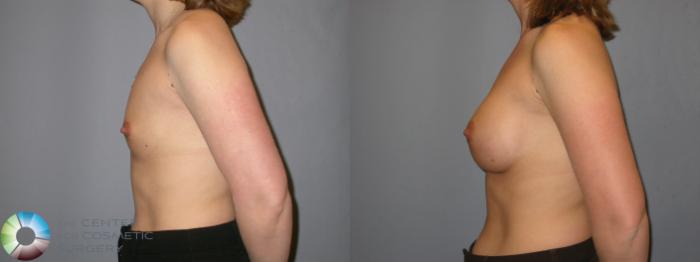 Before & After Breast Augmentation Case 114 View #3 in Denver and Colorado Springs, CO