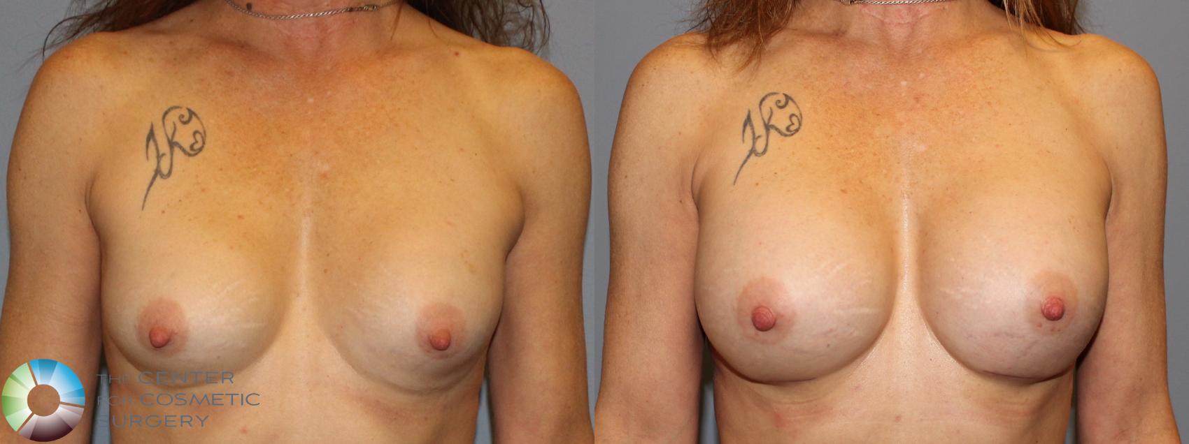 Before & After Breast Augmentation Case 11420 Front in Denver and Colorado Springs, CO