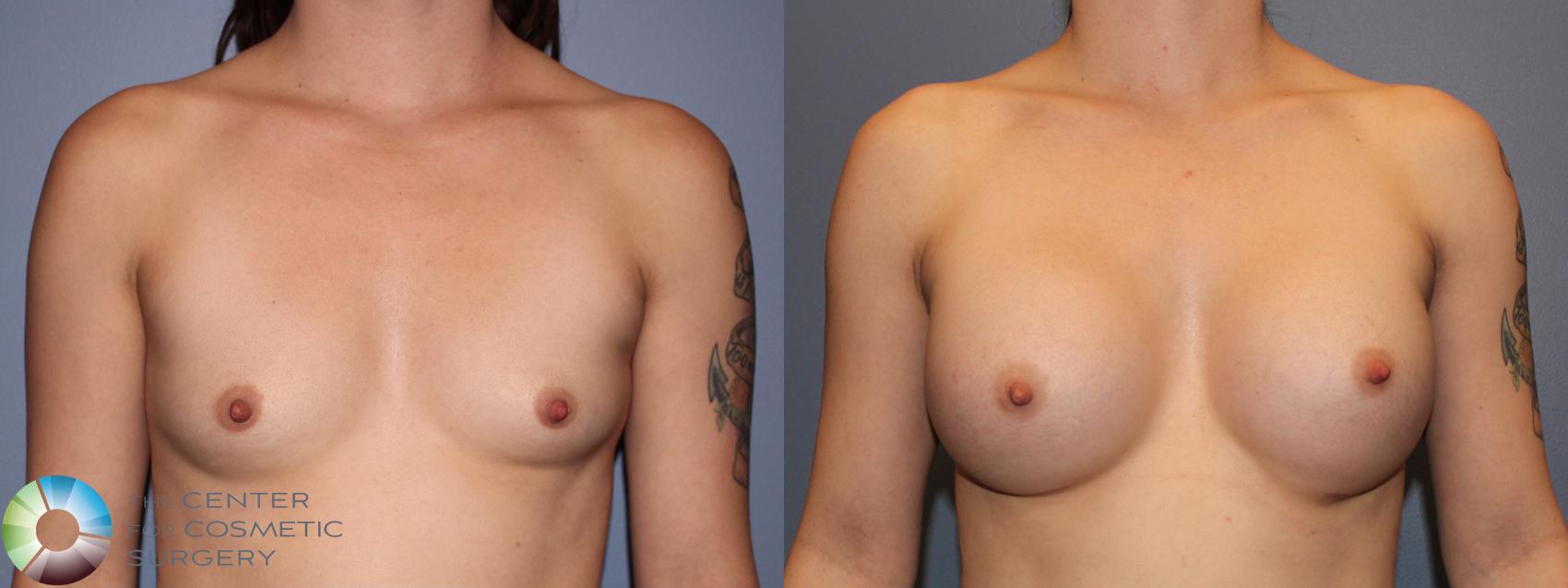 Before & After Breast Augmentation Case 11421 Front in Denver and Colorado Springs, CO