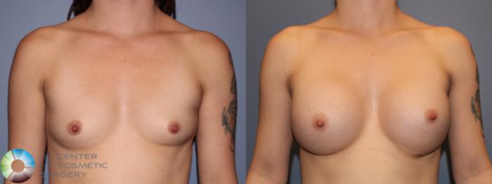 Before & After Breast Augmentation Case 11421 Front in Denver and Colorado Springs, CO