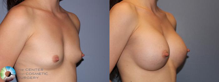 Before & After Breast Augmentation Case 11421 Right Oblique in Denver and Colorado Springs, CO