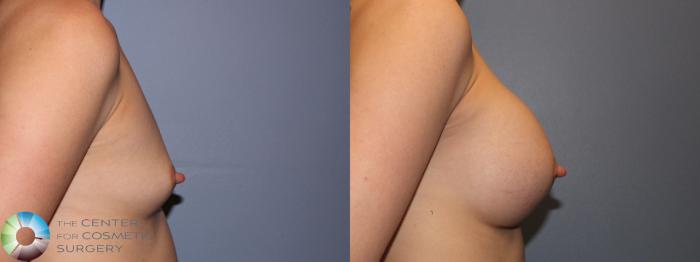 Before & After Breast Augmentation Case 11421 Right Side in Denver and Colorado Springs, CO