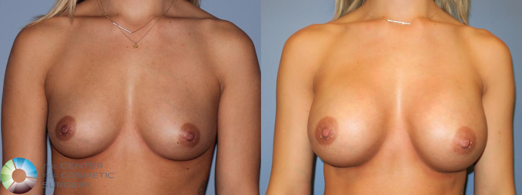 Before & After Breast Augmentation Case 11422 Front in Denver and Colorado Springs, CO
