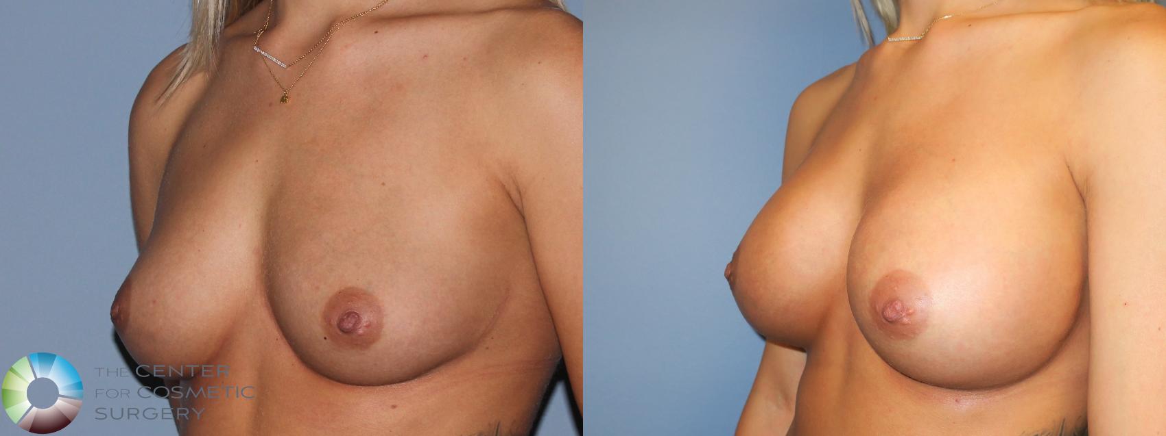 Before & After Breast Augmentation Case 11422 Left Oblique in Denver and Colorado Springs, CO