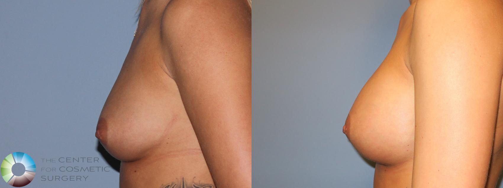Before & After Breast Augmentation Case 11422 Left Side in Denver and Colorado Springs, CO