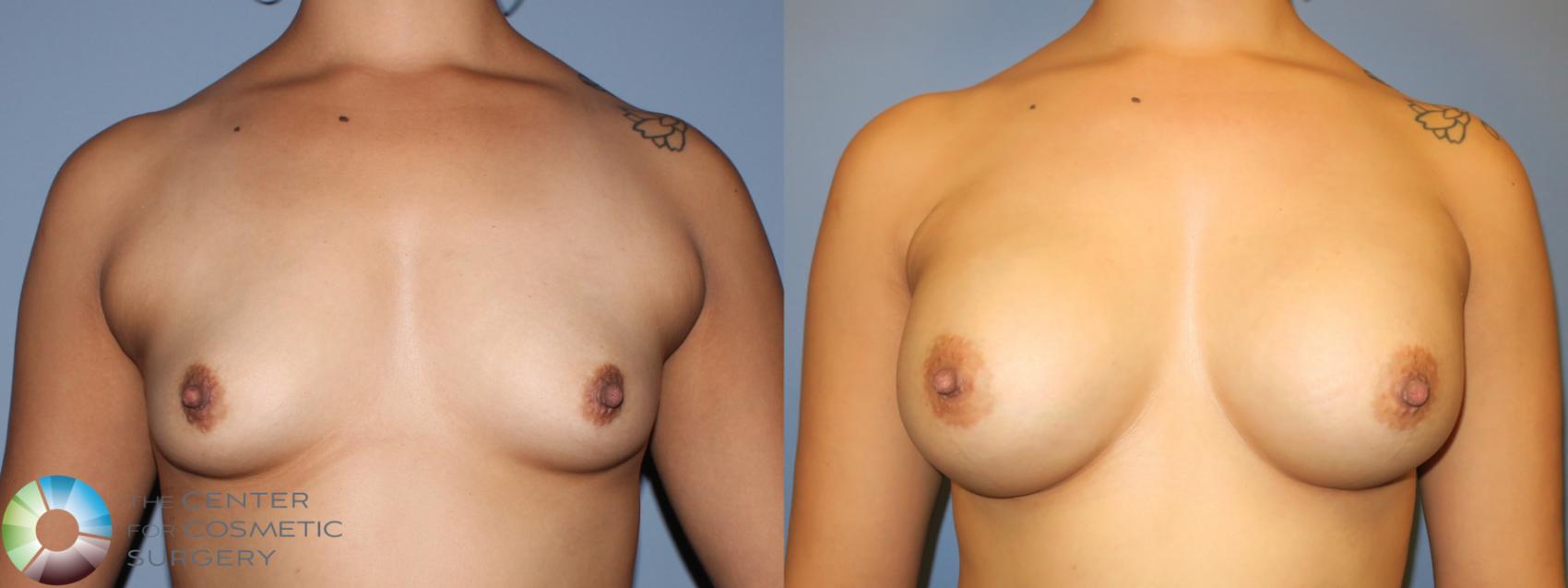 Before & After Breast Augmentation Case 11423 Front in Denver and Colorado Springs, CO