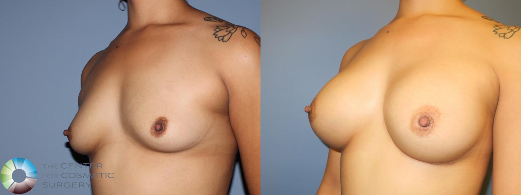 Before & After Breast Augmentation Case 11423 Left Oblique in Denver and Colorado Springs, CO