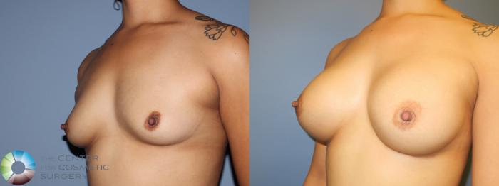 Before & After Breast Augmentation Case 11423 Left Oblique in Denver and Colorado Springs, CO