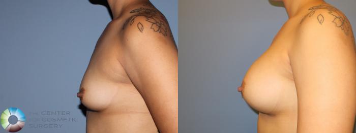 Before & After Breast Augmentation Case 11423 Left Side in Denver and Colorado Springs, CO