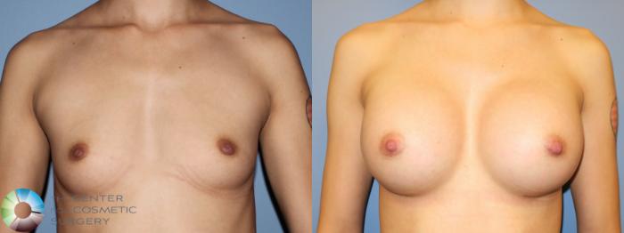 Before & After Breast Augmentation Case 11447 Front in Denver, CO