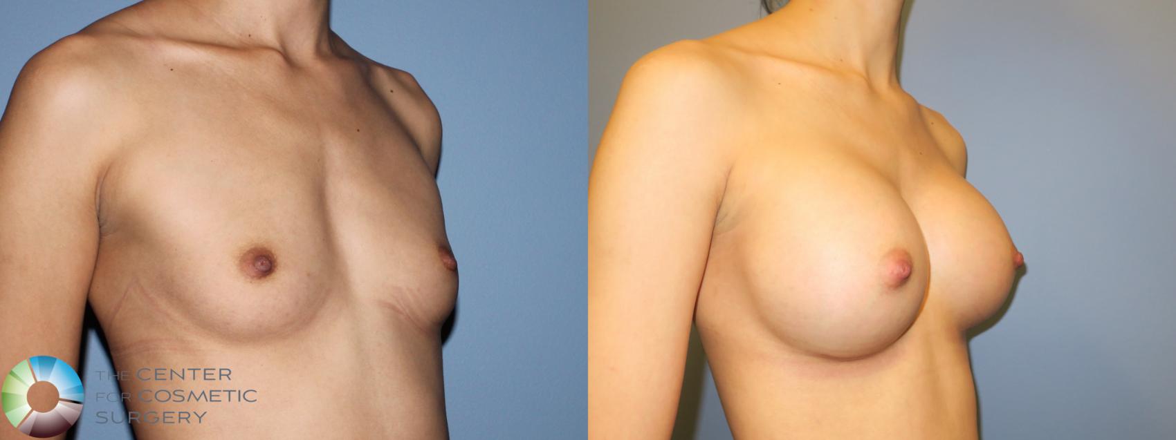 Before & After Breast Augmentation Case 11447 Right Oblique in Denver and Colorado Springs, CO
