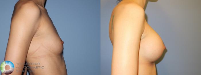 Before & After Breast Augmentation Case 11447 Right Side in Denver, CO
