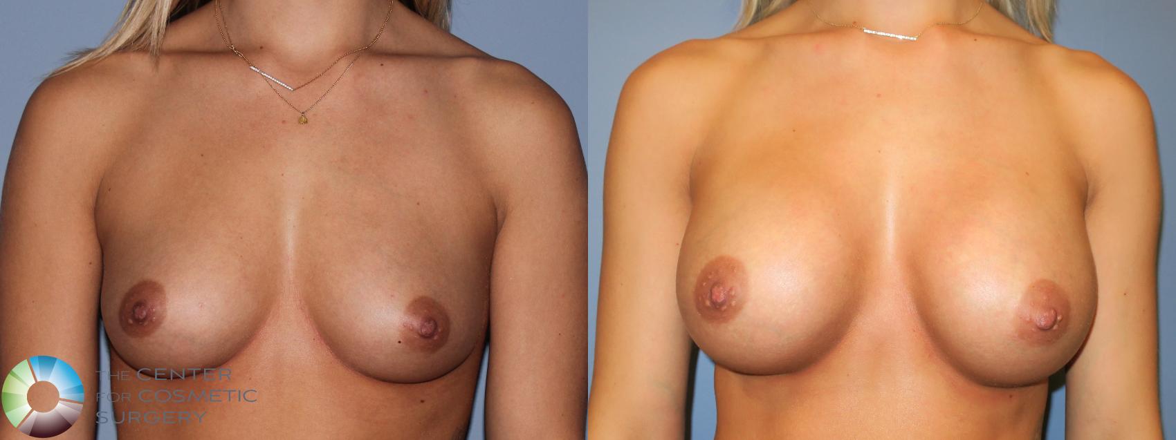 Before & After Breast Augmentation Case 11448 Front in Denver and Colorado Springs, CO
