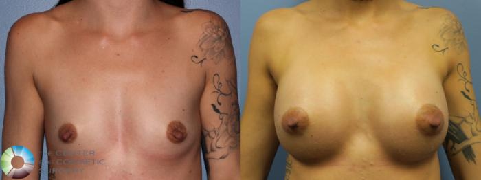 Before & After Breast Augmentation Case 11455 Front in Denver, CO