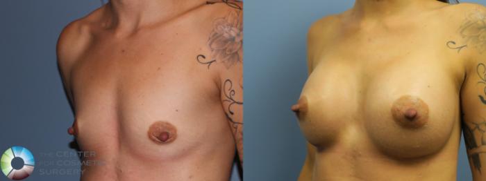 Before & After Breast Augmentation Case 11455 Left Oblique in Denver, CO