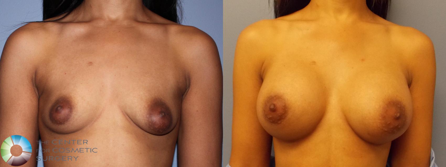 Before & After Breast Augmentation Case 11456 Front in Denver and Colorado Springs, CO