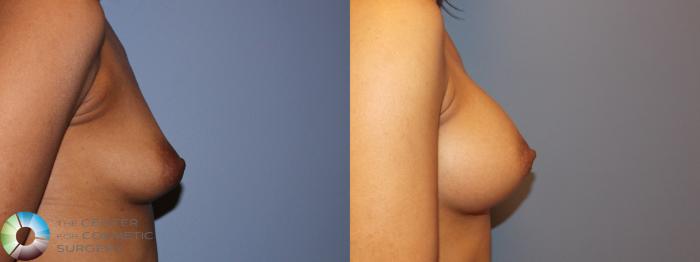 Best Natural Denver Breast Implants Augmentation