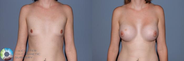 Before & After Breast Augmentation Case 11467 Front View in Golden, CO