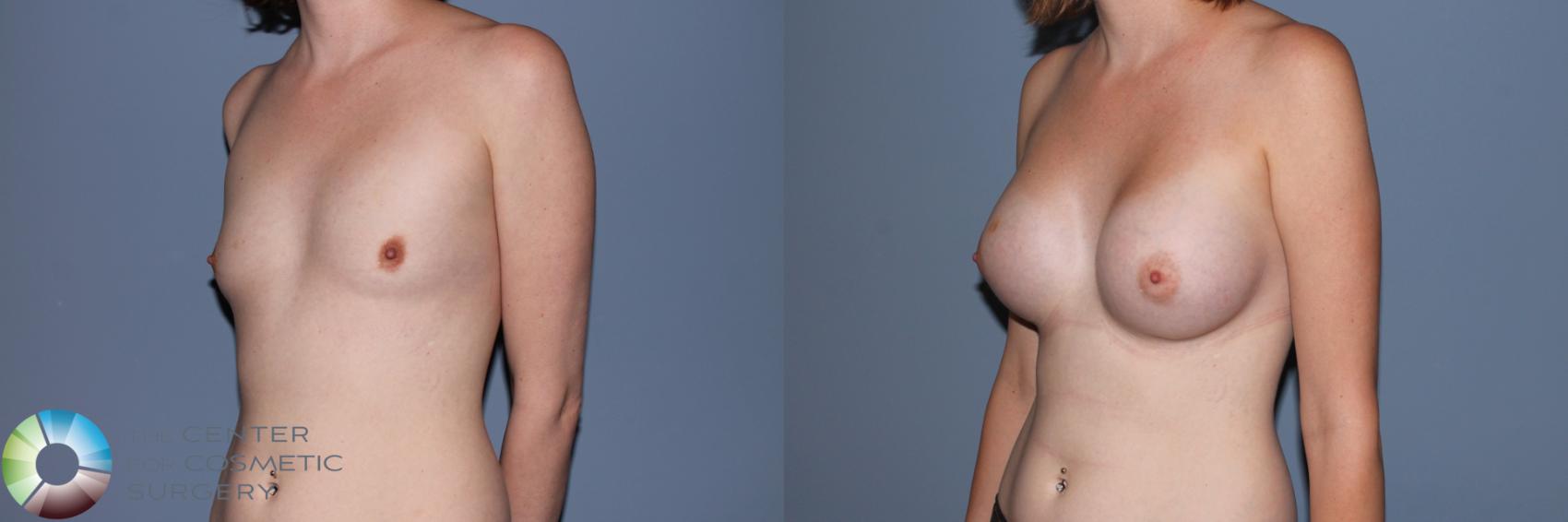 Before & After Breast Augmentation Case 11467 Left Oblique View in Golden, CO