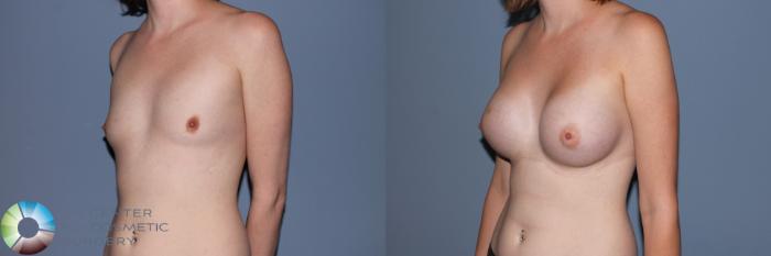 Before & After Breast Augmentation Case 11467 Left Oblique View in Golden, CO