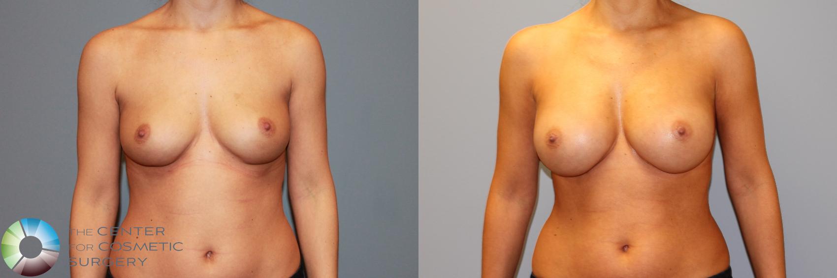 Before & After Breast Augmentation Case 11469 Front View in Golden, CO