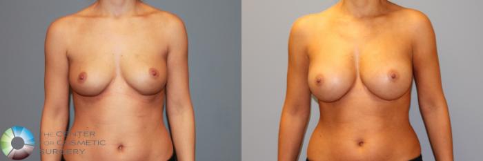 Before & After Breast Augmentation Case 11469 Front in Denver and Colorado Springs, CO