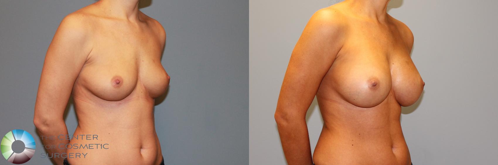 Before & After Breast Augmentation Case 11469 Right Oblique View in Golden, CO