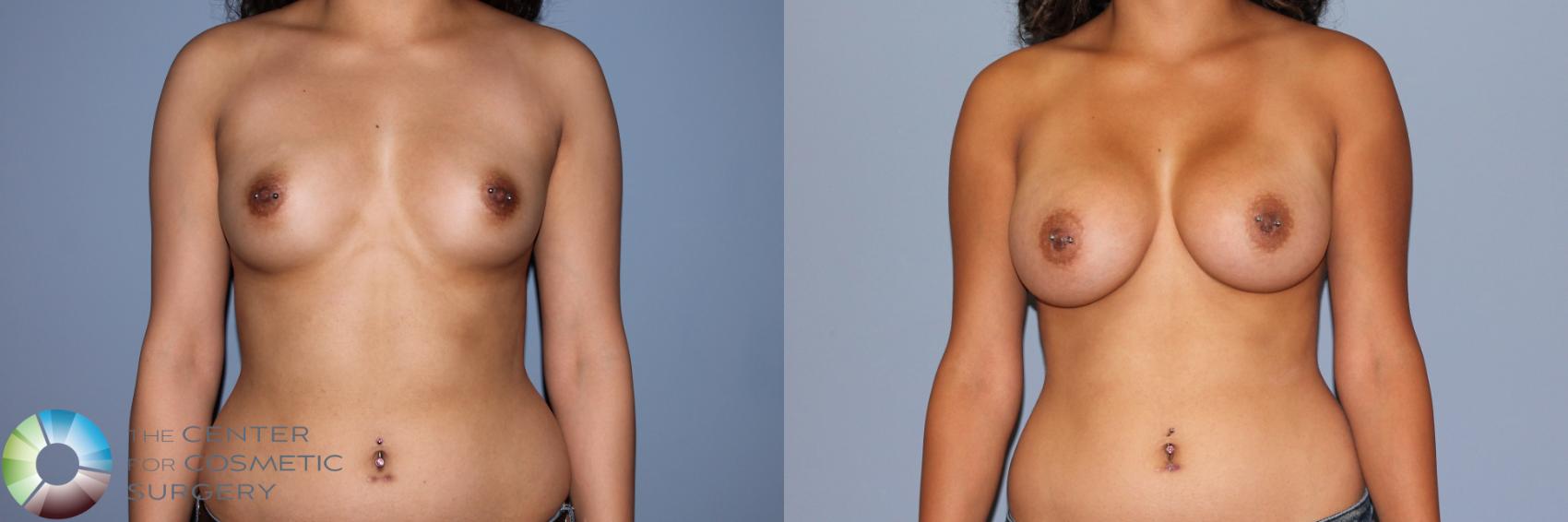 Before & After Breast Augmentation Case 11472 Front in Denver, CO