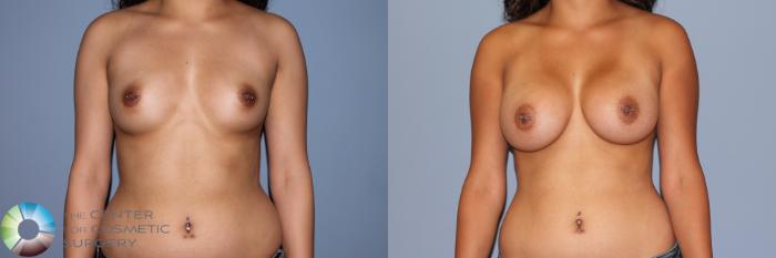 Before & After Breast Augmentation Case 11472 Front View in Golden, CO