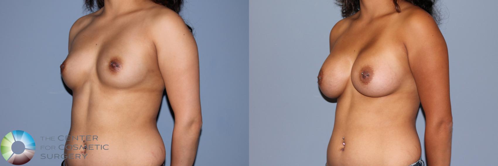 Before & After Breast Augmentation Case 11472 Left Oblique in Denver and Colorado Springs, CO