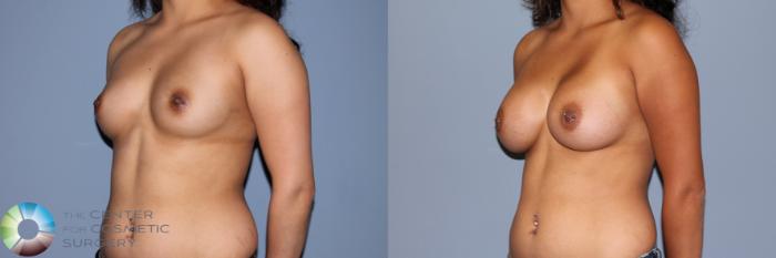 Before & After Breast Augmentation Case 11472 Left Oblique View in Golden, CO