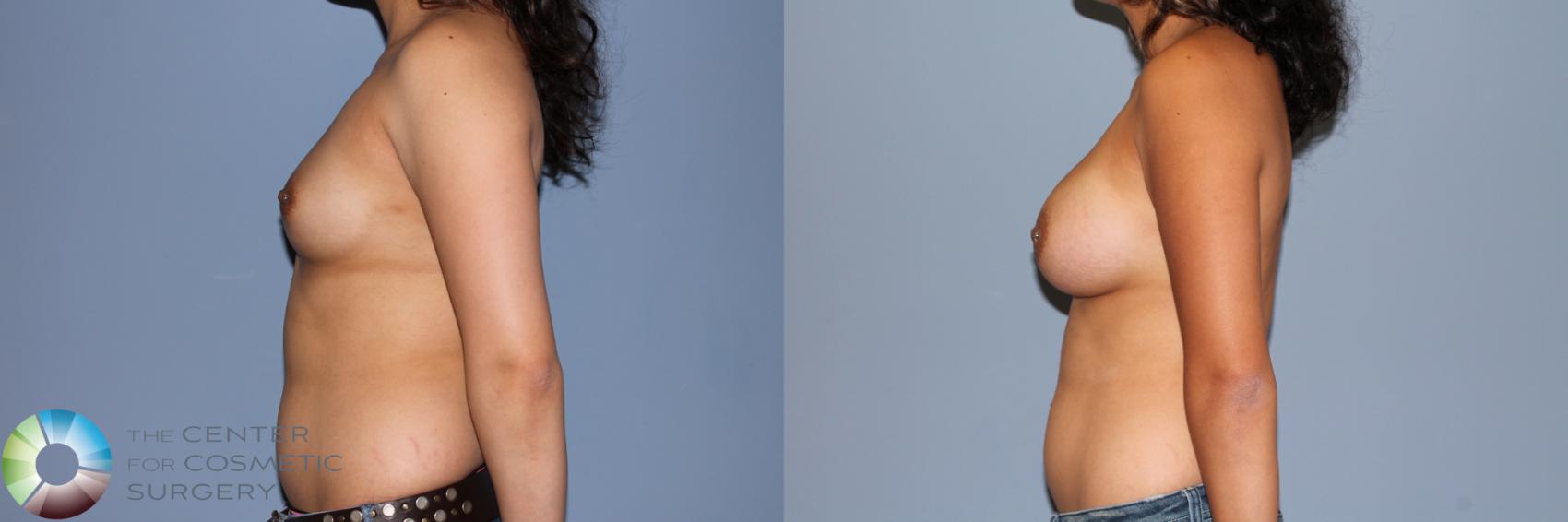 Before & After Breast Augmentation Case 11472 Left Side in Denver and Colorado Springs, CO