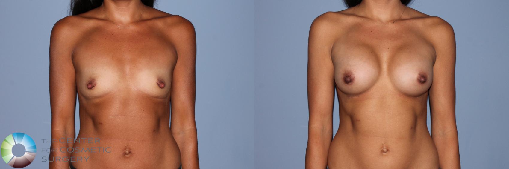 Before & After Breast Augmentation Case 11473 Front View in Golden, CO