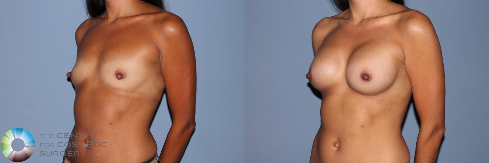 Before & After Breast Augmentation Case 11473 Left Oblique in Denver and Colorado Springs, CO