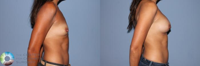 Before & After Breast Augmentation Case 11473 Right Side View in Golden, CO