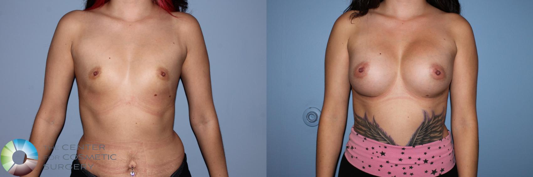 Before & After Breast Augmentation Case 11493 Front in Denver and Colorado Springs, CO