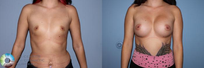Before & After Breast Augmentation Case 11493 Front View in Golden, CO