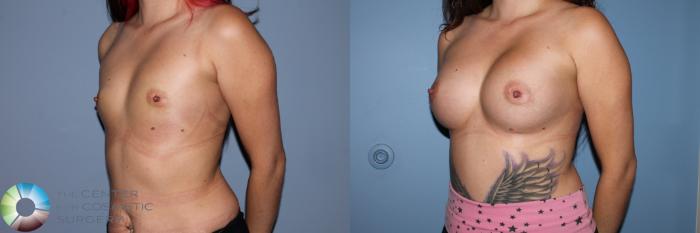 Before & After Breast Augmentation Case 11493 Left Oblique View in Golden, CO