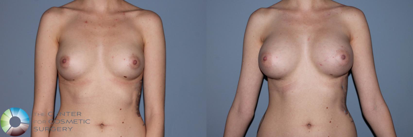 Before & After Breast Augmentation Case 11497 Front in Denver and Colorado Springs, CO