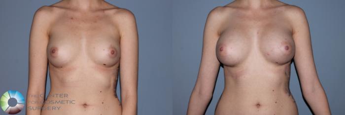Before & After Breast Augmentation Case 11497 Front View in Golden, CO