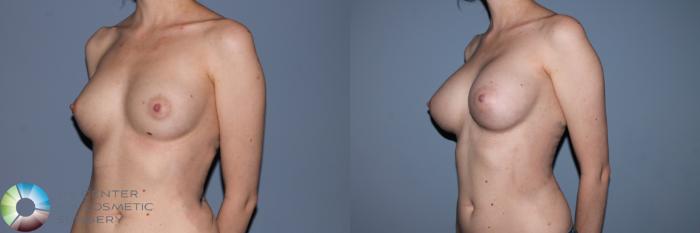 Before & After Breast Augmentation Case 11497 Left Oblique View in Golden, CO