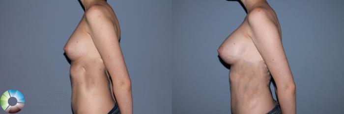 Before & After Breast Augmentation Case 11497 Left Side View in Golden, CO
