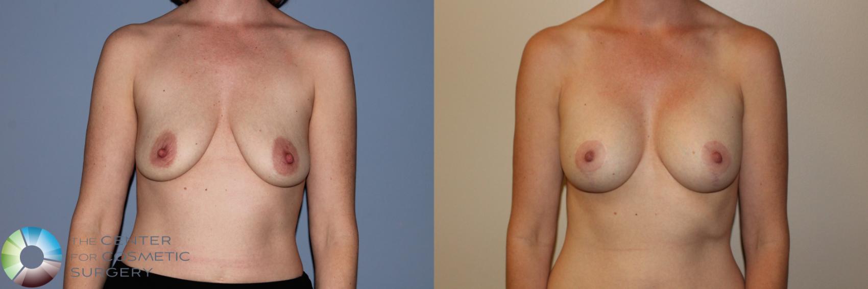 Before & After Breast Augmentation Case 11499 Front in Denver and Colorado Springs, CO