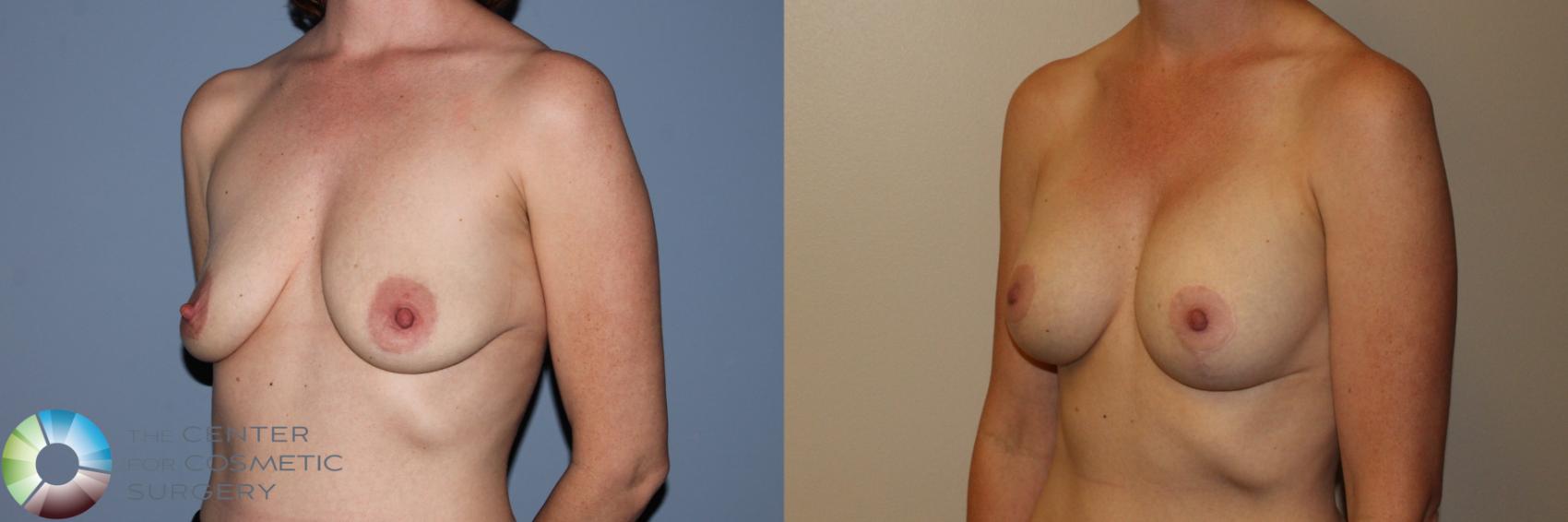 Before & After Breast Augmentation Case 11499 Left Oblique View in Golden, CO