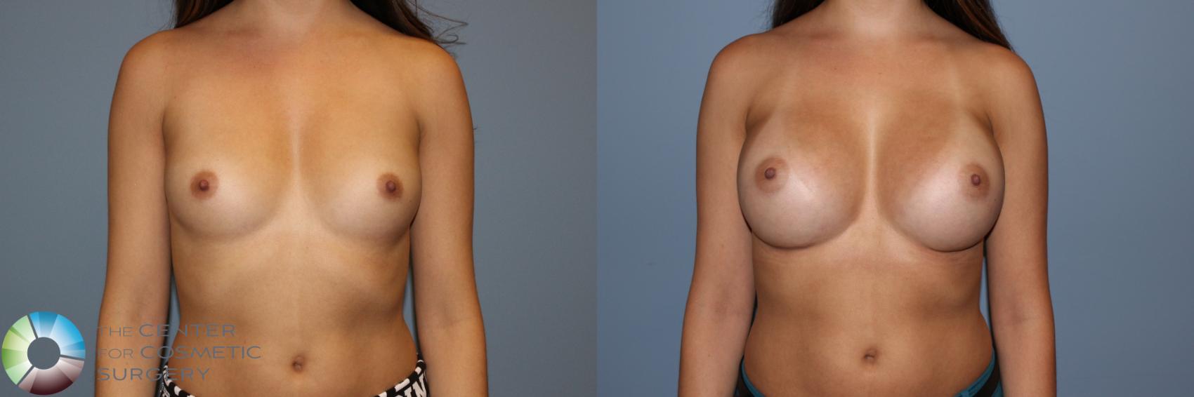 Before & After Breast Augmentation Case 11502 Front View in Denver & Golden, CO