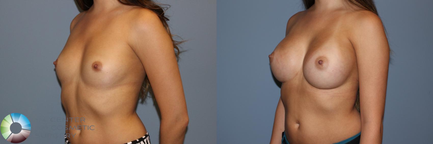Before & After Breast Augmentation Case 11502 Left Oblique View in Denver & Golden, CO